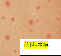 带你了解带状疱疹的前世今生(图1)