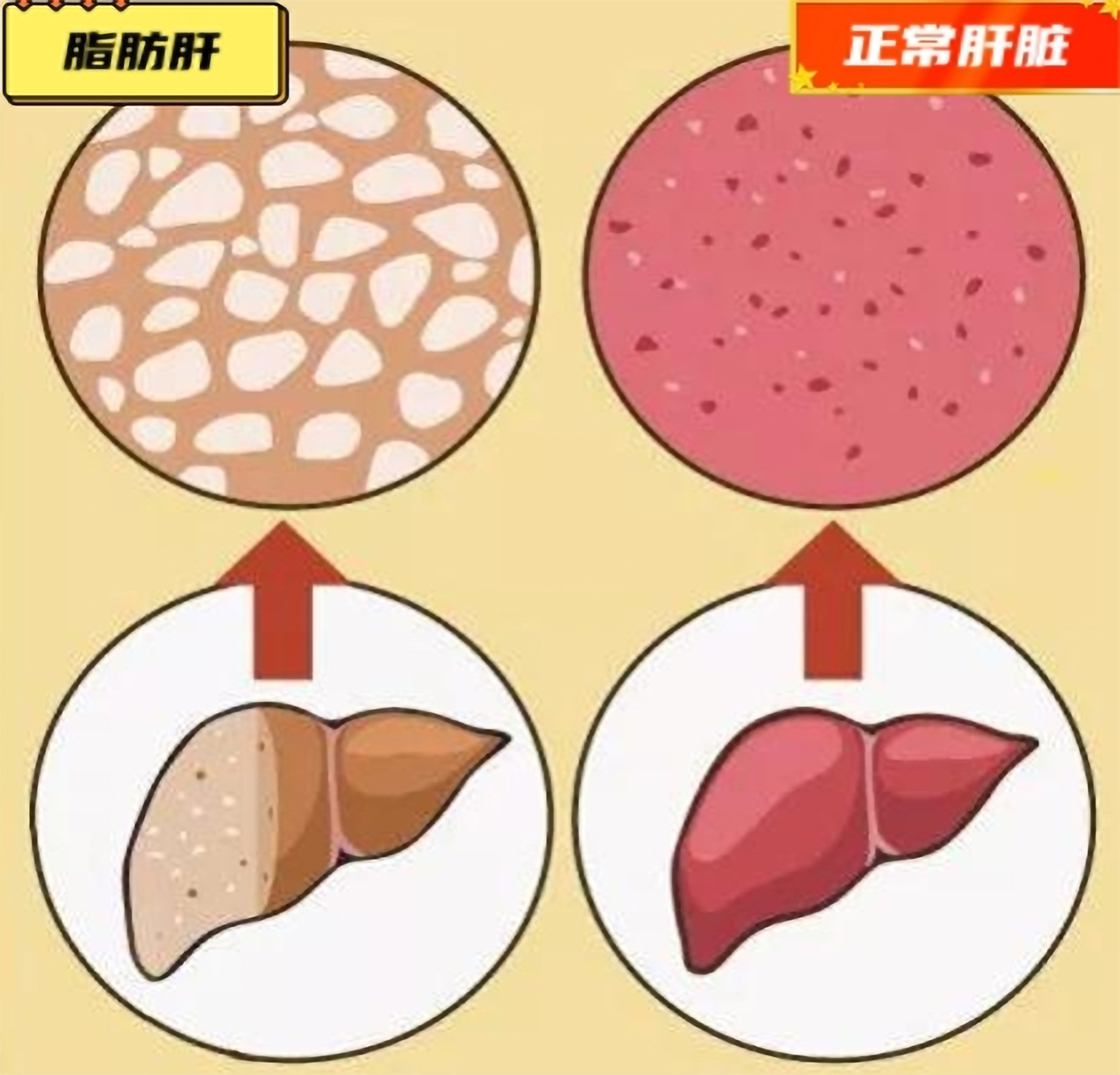 你的肝脏需要减肥吗？(图1)