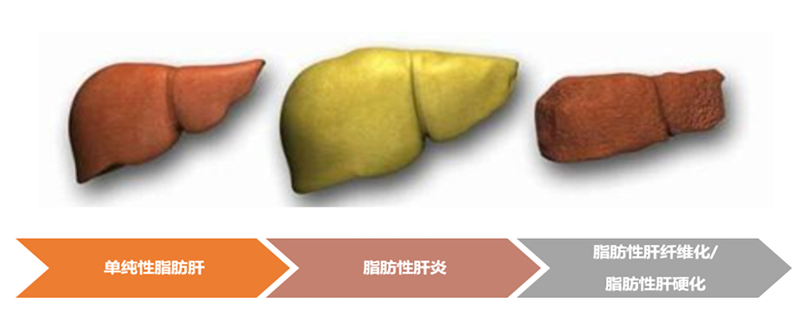 你的肝脏需要减肥吗？(图2)