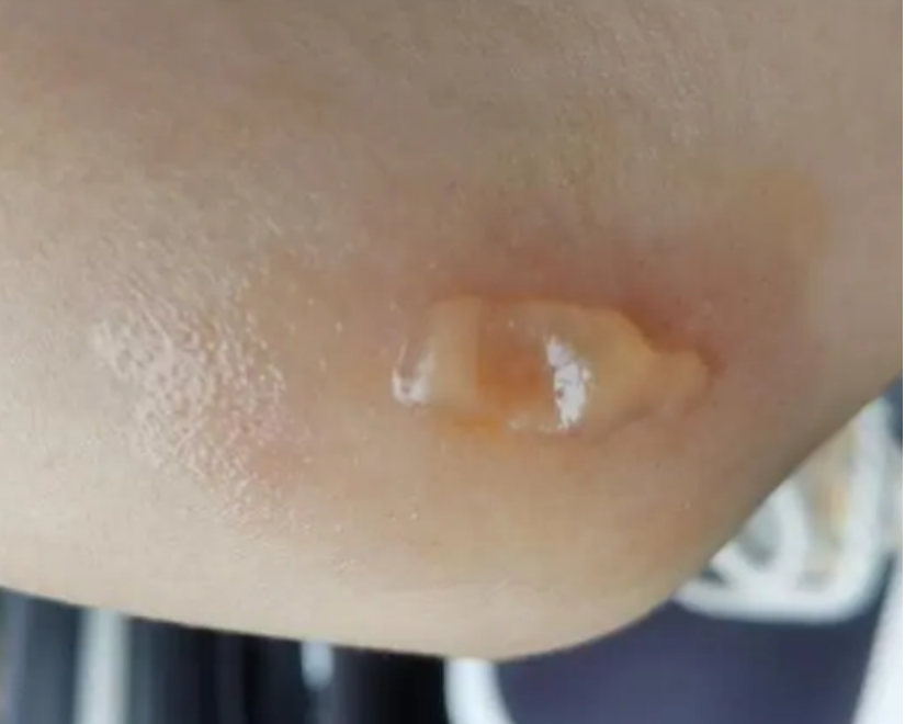 寒流来袭，不要忽视这一类烫伤！(图2)
