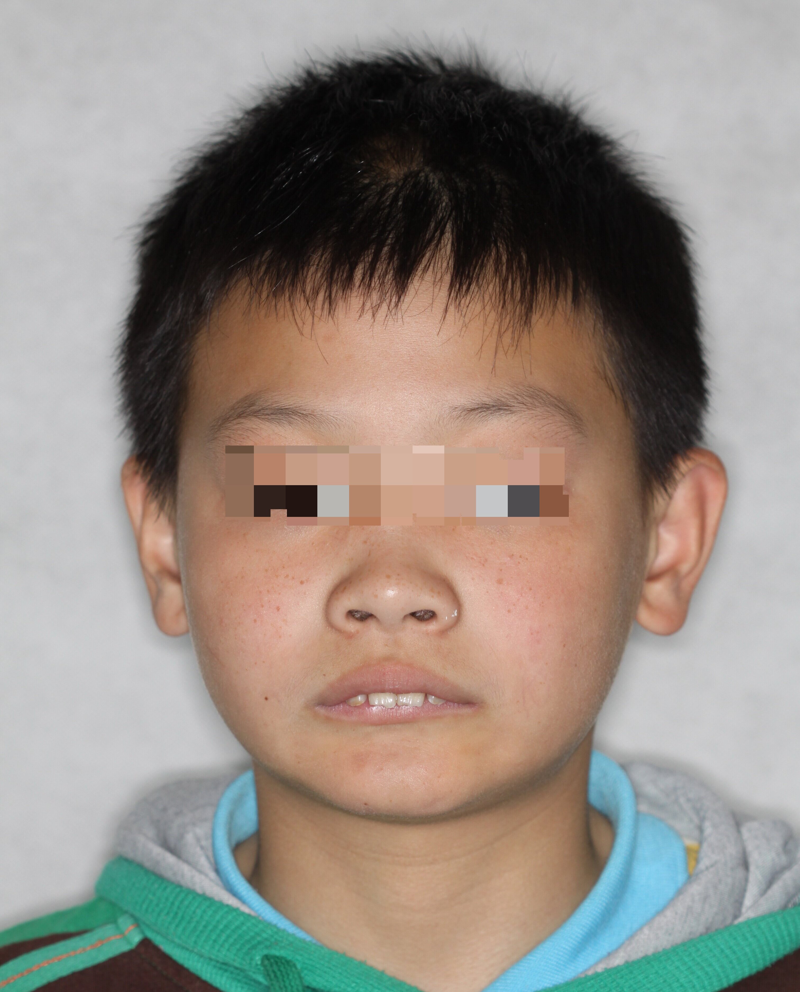 关于儿童牙齿矫正那些事(图10)